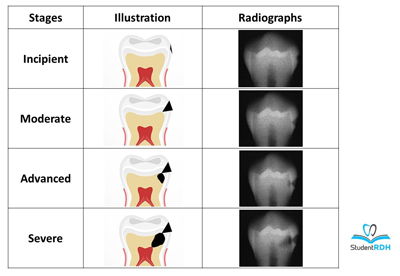 decay tooth dental cavities caries classifications classification types incipient advanced teeth sugar moderate stages enamel severe apollonia